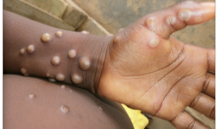 Monkeypox 723x430 1